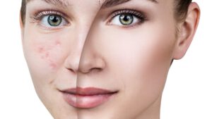 Mijn manier om om te gaan met de rosacea acne – Azelac mousturising gel van Sesderma